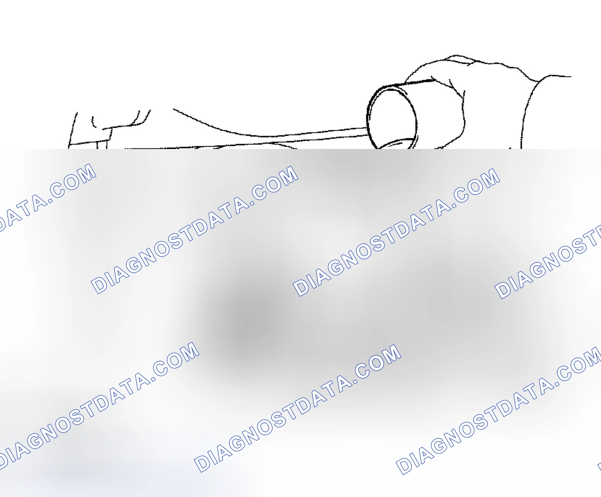 Scheme 94: BLEEDING