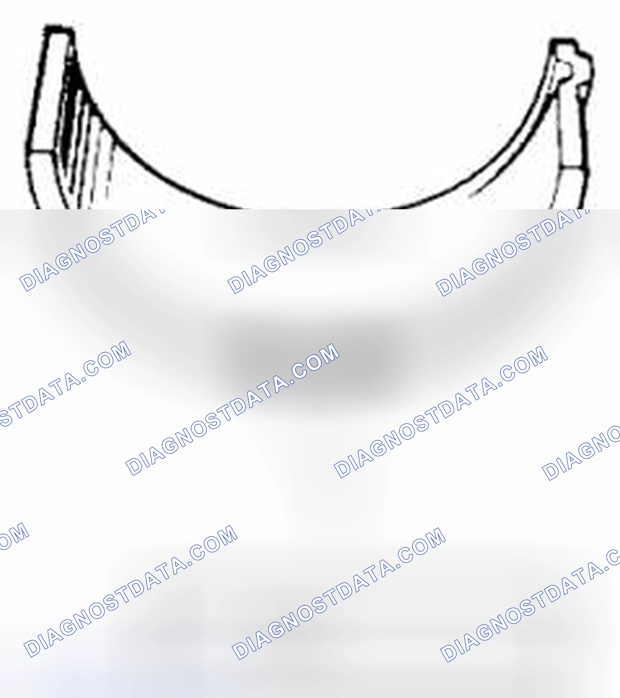 Scheme 209: Undersize bearing (0.25 mm)
