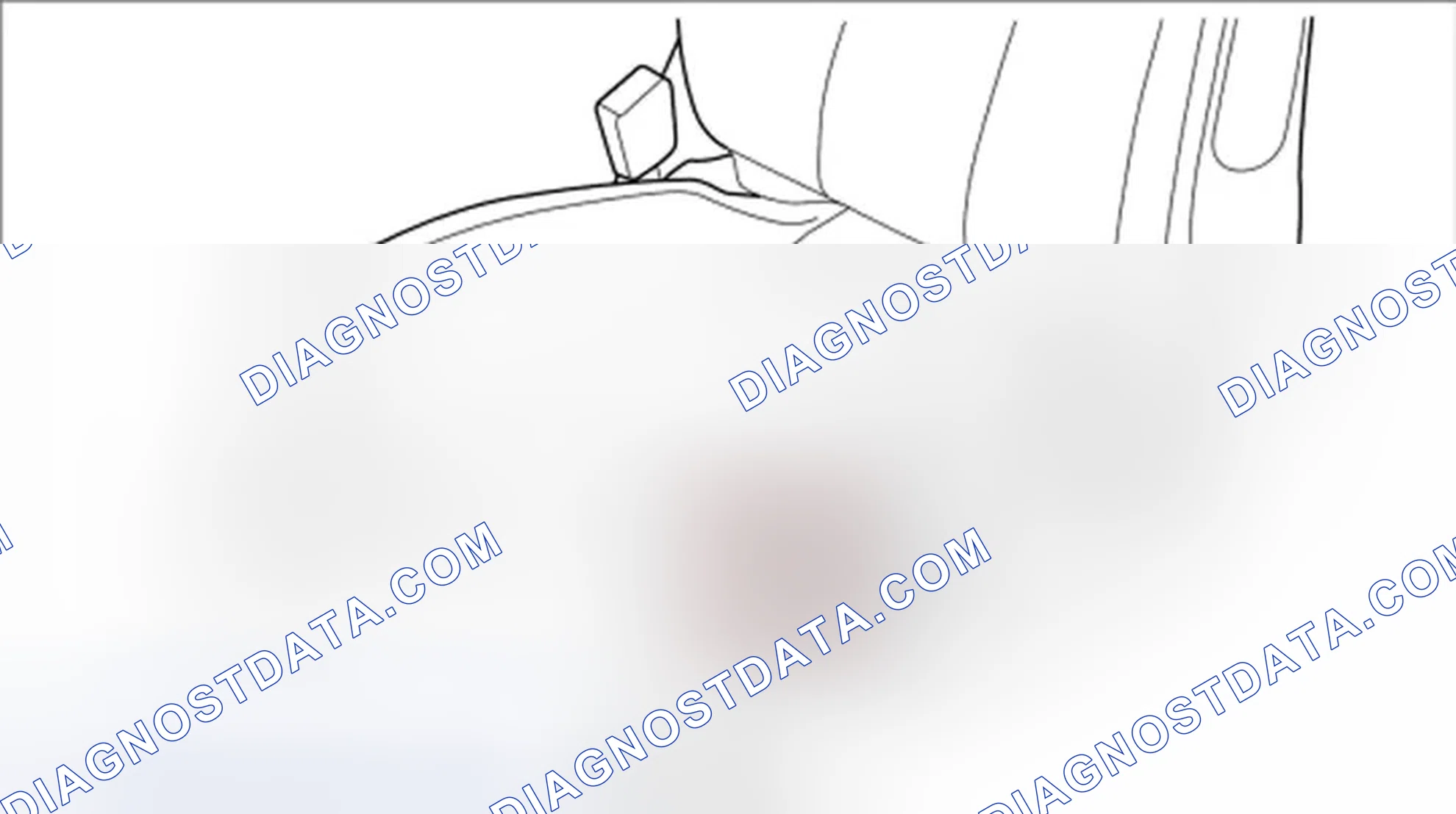 Scheme 22: Removing motor for front vertical adjustment