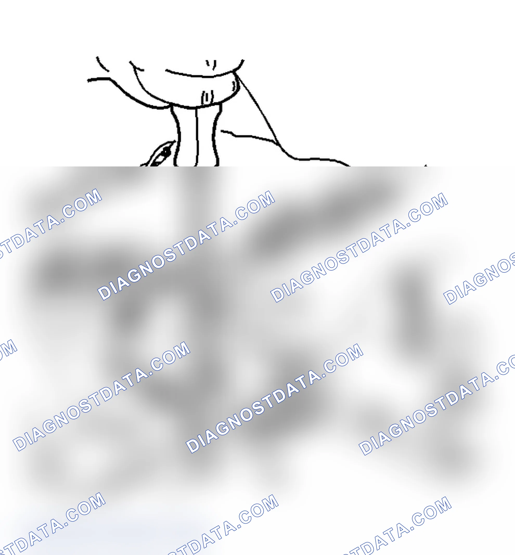 Scheme 157: Forward Servo Removal